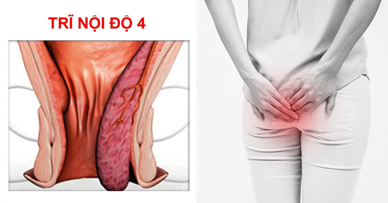 Bệnh trĩ nội độ 4 – Cách điều trị và phòng biến chứng