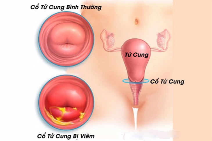 Viêm cổ tử cung mãn tính: Triệu chứng nguy hiểm chị em cần điều trị sớm