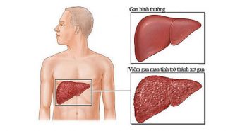 5 phương pháp phòng bệnh viêm gan C hiệu quả
