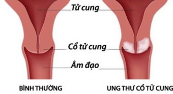 Bệnh viêm lộ tuyến cổ tử cung có gây ung thư?