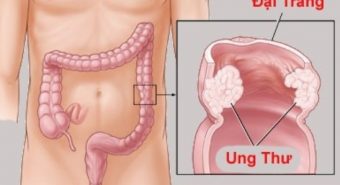 Mắc ung thư đại tràng từ những thói quen ít ai để ý