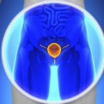 Chẩn đoán ung thư tiền liệt tuyến chính xác bằng tinh dịch