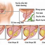 Dấu hiệu ung thư tuyến tiền liệt các quý ông nên biết