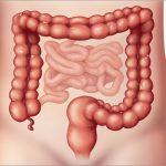 Đối tượng nào dễ mắc bệnh ung thư đại tràng?