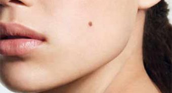 Không nên xem thường những triệu chứng ung thư da