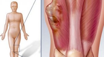 Hơi nước nóng – “Khắc tinh” của tế bào ung thư xương