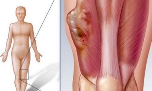 Hơi nước nóng – “Khắc tinh” của tế bào ung thư xương