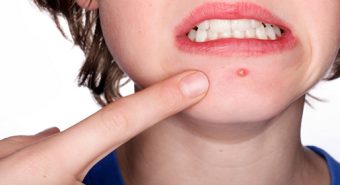 Làm sao để phân biệt ung thư da với mụn nhọt thông thường?