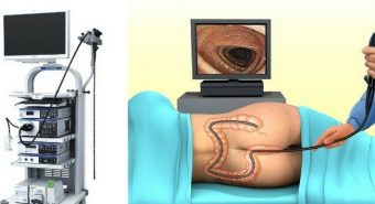 Làm xét nghiệm để chẩn đoán bệnh viêm đại tràng