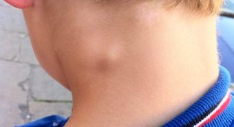 Nhận biết ung thư hạch qua các dấu hiệu thường gặp