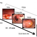 Phát hiện ung thư đại tràng thông qua khám sàng lọc
