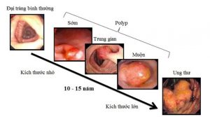 Phát hiện ung thư đại tràng sớm để có những phương pháp điều trị hiệu quả.