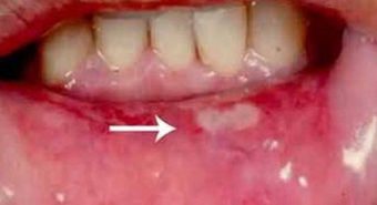 Tìm hiểu ung thư biểu mô tế bào vùng miệng