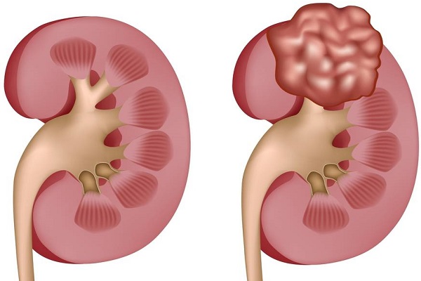 Ung thư biểu mô tế bào thận rất khó phát hiện ở giai đoạn đầu