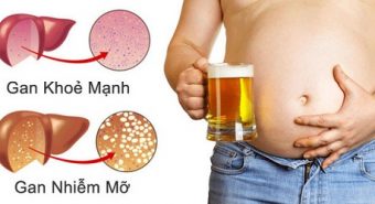Bệnh gan nhiễm mỡ khó nhận biết nhưng nguy hiểm