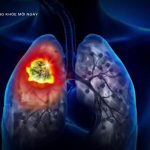 Nguyên Nhân Và Cách Phòng Tránh Ung Thư