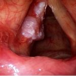 Bệnh ung thư thanh quản có điều trị được không?