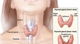 Bị ung thư tuyến giáp có điều trị khỏi không?