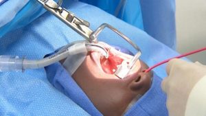 Tử vong là biến chứng của cắt amidan vô cùng nguy hiểm