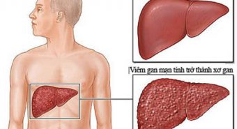 Cẩn trọng với những biến chứng viêm gan B mạn tính nguy hiểm