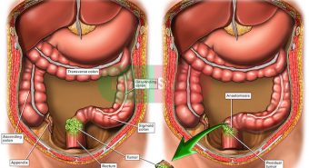 Cách chăm sóc bệnh nhân sau mổ ung thư đại trực tràng