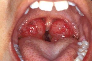 Biểu hiện của viêm amidan