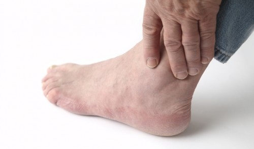 Hãy cẩn trọng với dấu hiệu sưng bàn chân