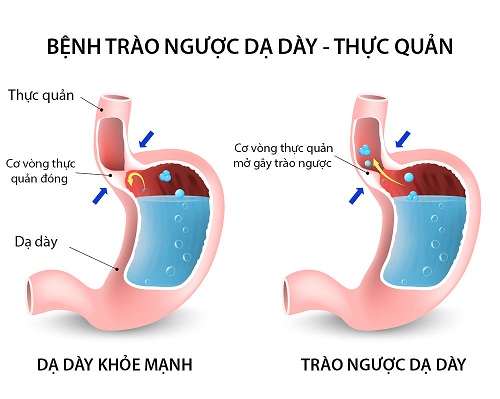 Chữa trào ngược dạ dày thực quản bằng mẹo