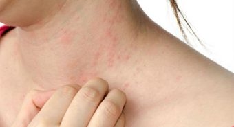 Chung sống “hòa bình” với bệnh vảy nến mạn tính