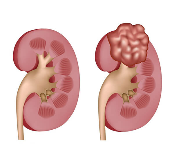 Phát hiện sớm nguồn bệnh để có phương pháp điều trị ung thư thận hiệu quả nhất