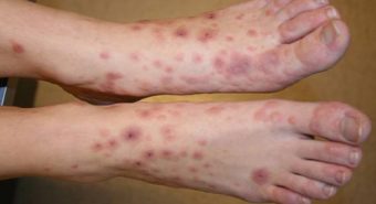 Cách tránh vòng xoắn bệnh lý viêm da cơ địa