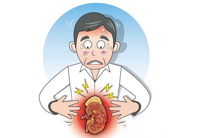 Triệu chứng ung thư thận giai đoạn đầu thường không rõ ràng