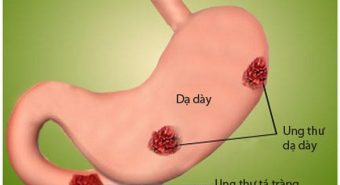 Dấu hiệu ung thư dạ dày ngoài những cơn đau