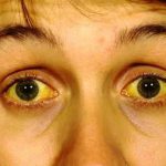 Dấu hiệu viêm gan B cấp tính bạn cần biết để điều trị kịp thời