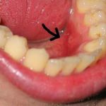 Vết loét có phải là dấu hiệu của ung thư khoang miệng không?