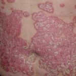 Hiệu quả không ngờ từ phương pháp điều trị vảy nến bằng thảo dược