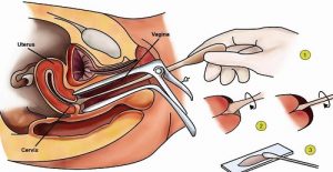 nhận biết sớm ung thư cổ tử cung