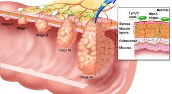 Loại dầu có thể diệt tới 90% tế bào ung thư đại tràng