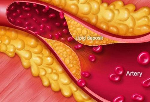 Mỡ máu gây nên hàng loạt các căn bệnh nguy hiểm