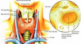 Một số dấu hiệu nhận biết ung thư tuyến giáp