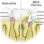 Bệnh nha chu có thể phát triển thành bệnh ung thư tuyến tụy không?