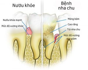 Bệnh nha chu có nguy cơ phát triển thành bệnh ung thư tuyến tụy