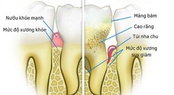 Bệnh nha chu có thể phát triển thành bệnh ung thư tuyến tụy không?