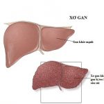 Những nguyên nhân gây xơ gan bạn có thể phòng tránh
