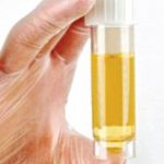 Nhìn nước tiểu chẩn đoán bệnh ung thư bàng quang