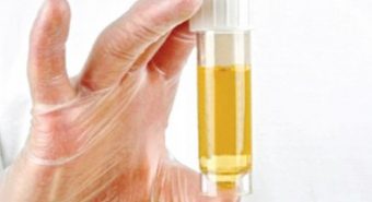 Nhìn nước tiểu chẩn đoán bệnh ung thư bàng quang