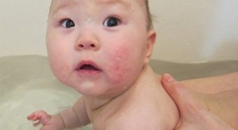Những cách xử lý khi bị viêm da cơ địa