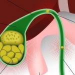 Những dấu hiệu phổ biến của bệnh ung thư túi mật
