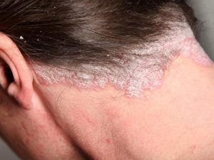 Lựa chọn các loại thuốc là khắc tinh trị bệnh vảy nến phù hợp với từng dạng bệnh