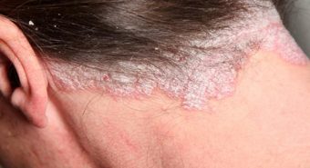Những điều cần biết về bệnh vảy nến và khắc tinh trị bệnh vảy nến